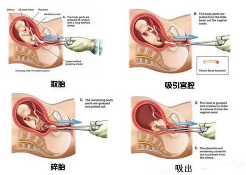 五个月怎么做引产，全面解析引产过程与注意事项