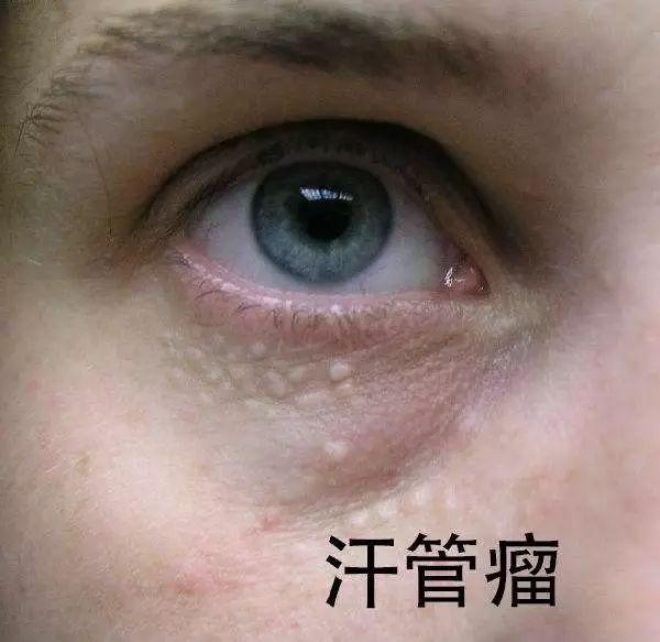 3个月宝宝眼皮红图片，解读婴儿眼部健康的奥秘